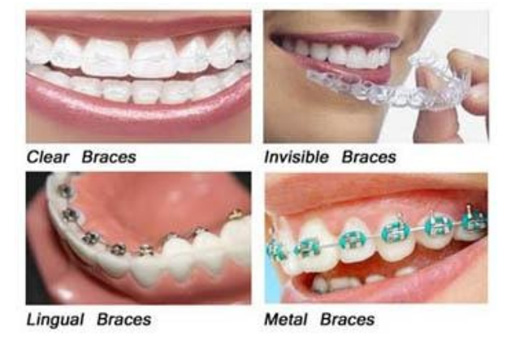 Braces